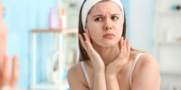 Adeus, acne! Faça você mesma essa máscara facial de até R$ 30